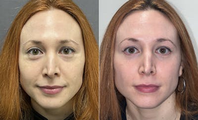 Lower Blepharoplasty Before & After Gallery - Patient 123125948 - Image 2