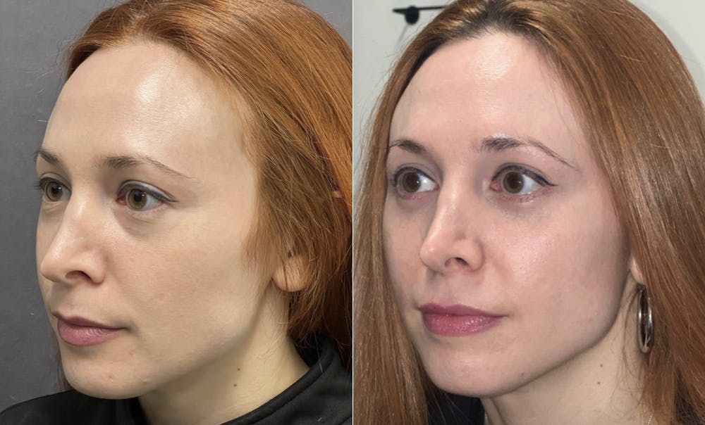 Lower Blepharoplasty Before & After Gallery - Patient 123125948 - Image 3