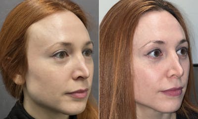 Lower Blepharoplasty Before & After Gallery - Patient 123125948 - Image 4