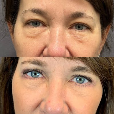 Lower Blepharoplasty Before & After Gallery - Patient 123127139 - Image 1