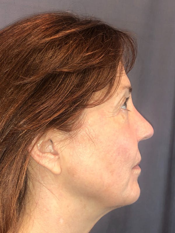Laser Resurfacing Before & After Gallery - Patient 208496 - Image 4