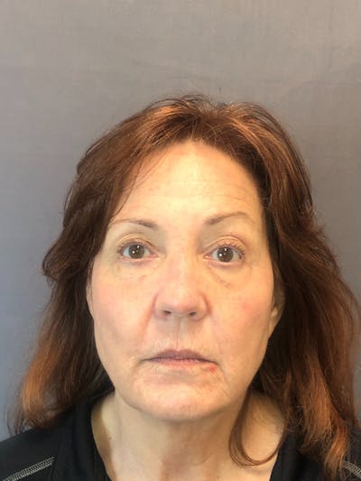 Laser Resurfacing Before & After Gallery - Patient 208496 - Image 10