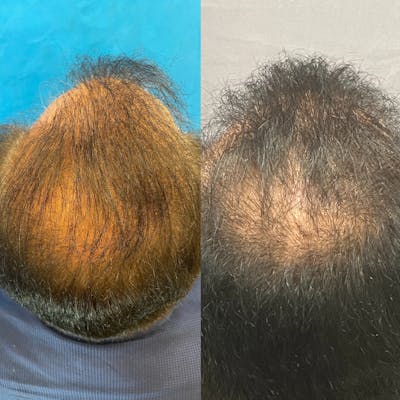 Hair Restoration  Before & After Gallery - Patient 141159469 - Image 1