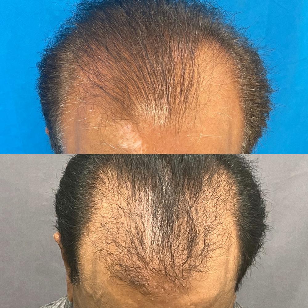 Hair Restoration  Before & After Gallery - Patient 141159469 - Image 2