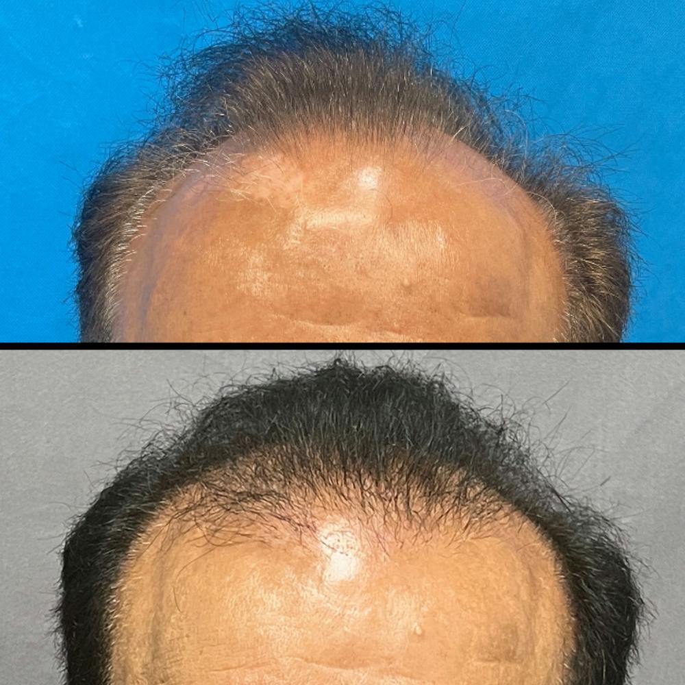 Hair Restoration  Before & After Gallery - Patient 141159469 - Image 3