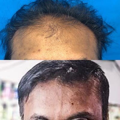 Hair Restoration  Before & After Gallery - Patient 141159478 - Image 1