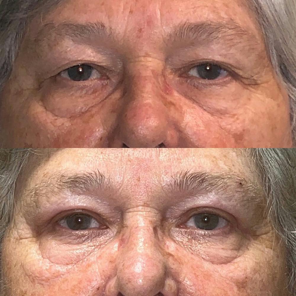 Upper Blepharoplasty Before & After Gallery - Patient 141201377 - Image 1
