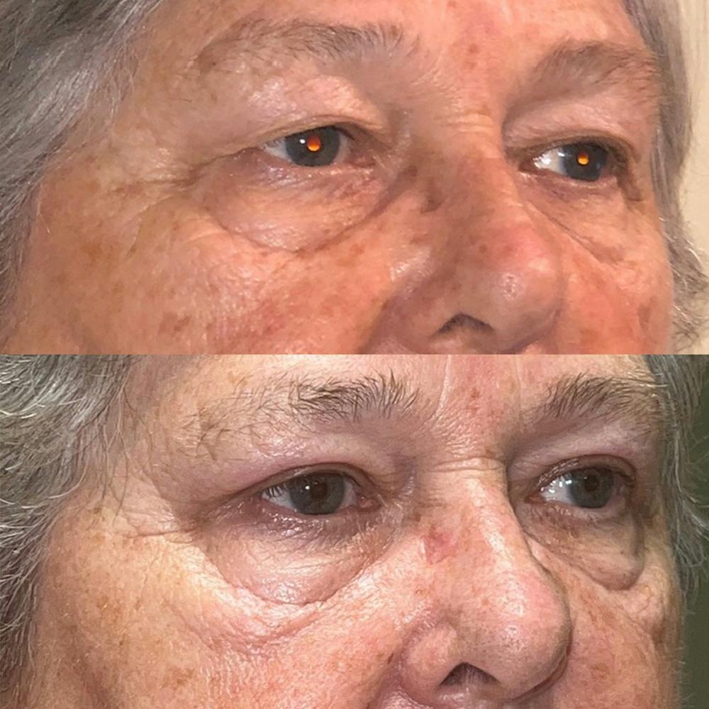 Upper Blepharoplasty Before & After Gallery - Patient 141201377 - Image 2