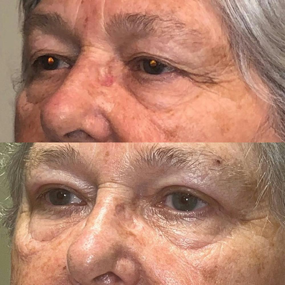 Upper Blepharoplasty Before & After Gallery - Patient 141201377 - Image 3