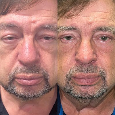 Ptosis Before & After Gallery - Patient 141201303 - Image 1