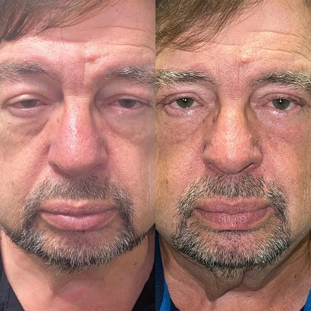 Ptosis Before & After Gallery - Patient 141201303 - Image 1