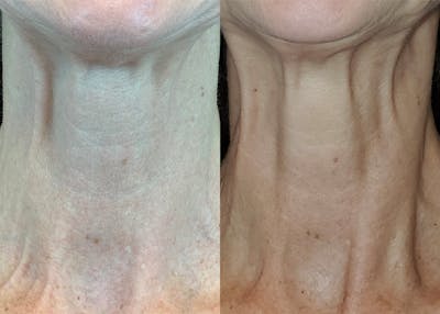 Dermal Fillers Before & After Gallery - Patient 141201398 - Image 1