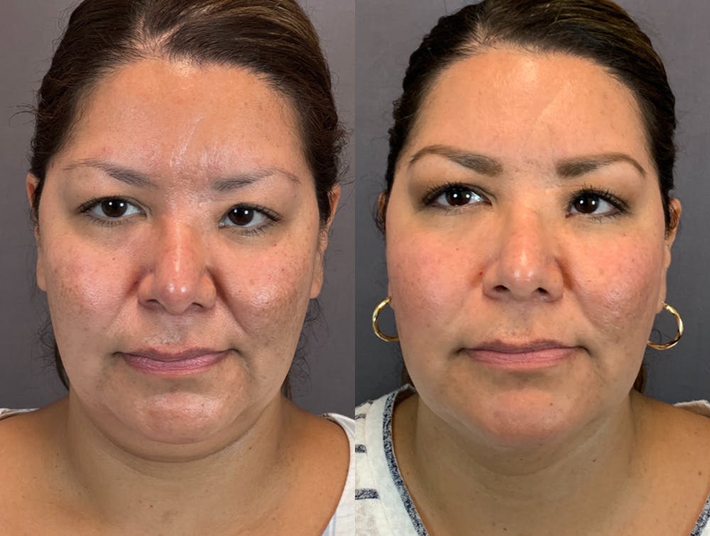 Submental Liposuction Before & After Gallery - Patient 141650999 - Image 1