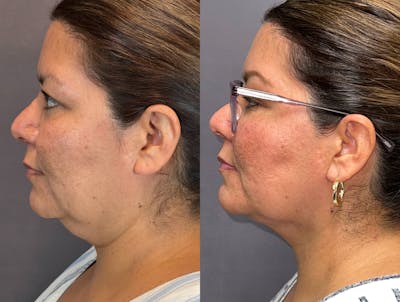 Facetite Before & After Gallery - Patient 141650998 - Image 2