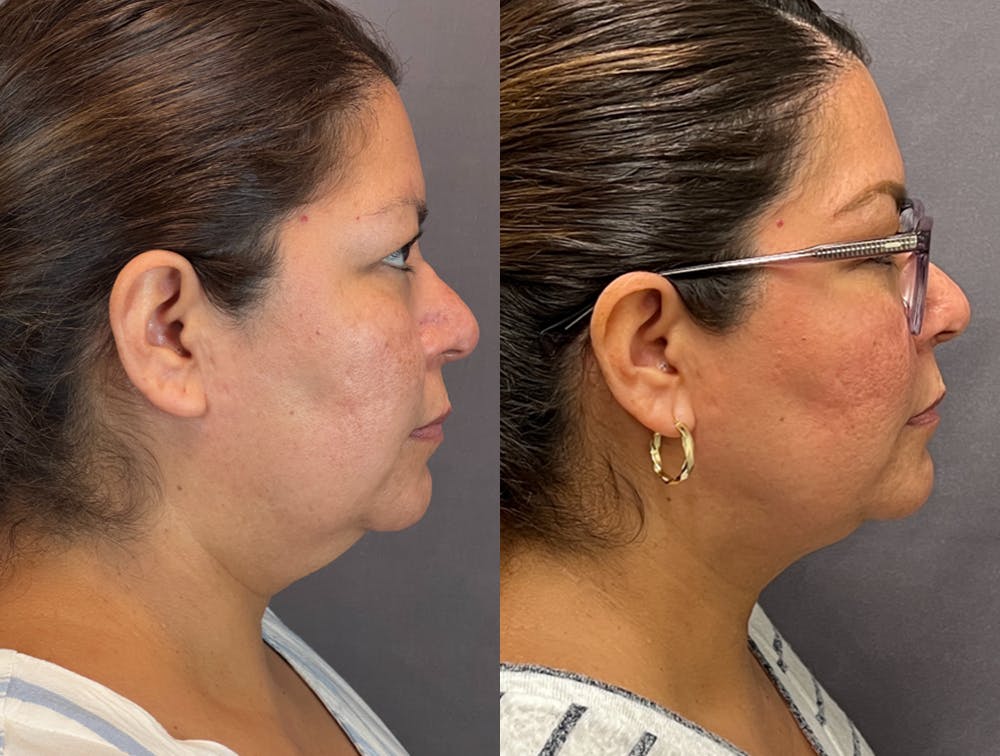 Submental Liposuction Before & After Gallery - Patient 141650999 - Image 3