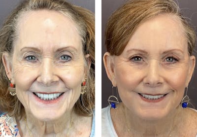 Facelift Before & After Gallery - Patient 122889161 - Image 1