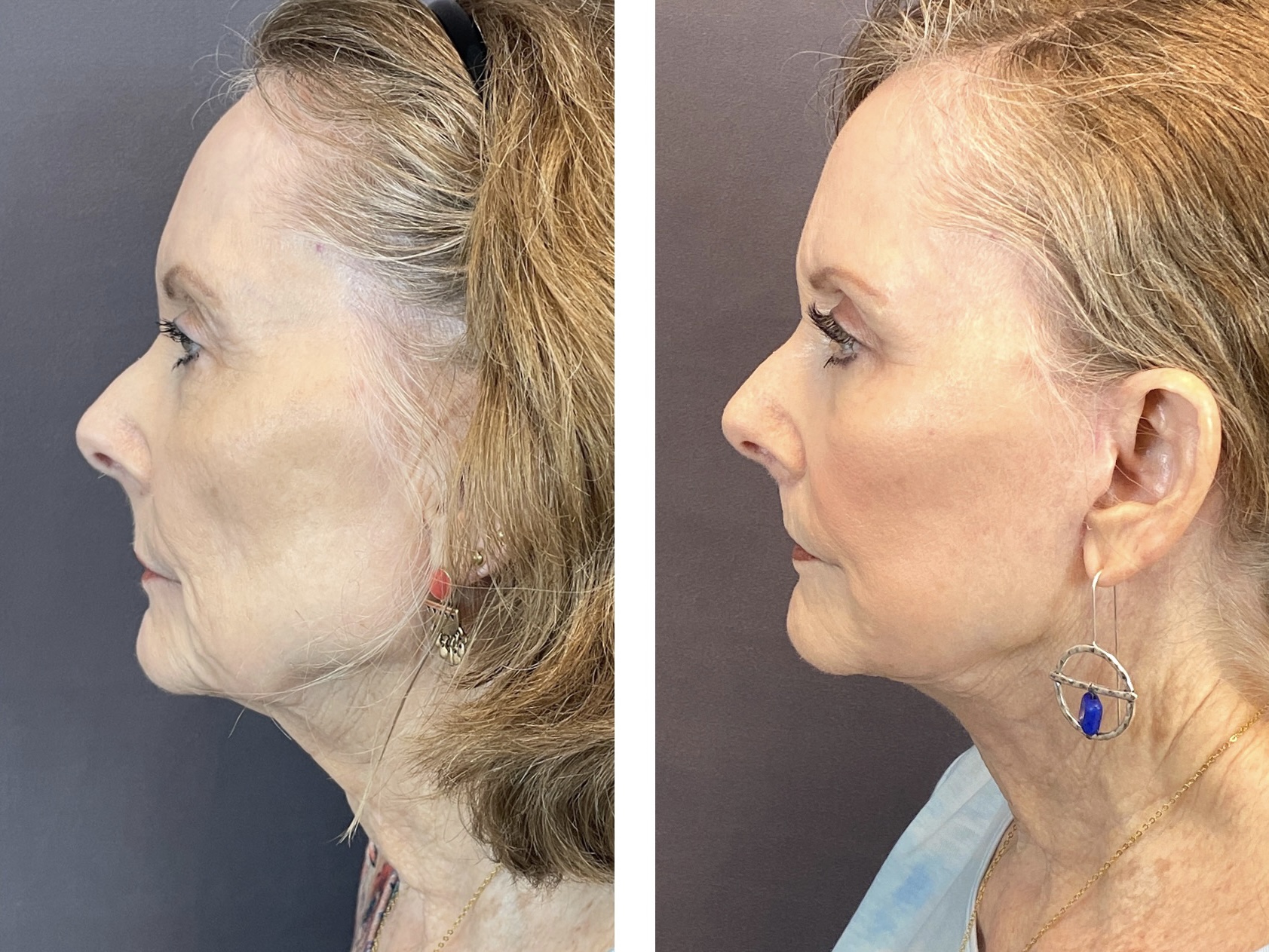 Patient 122889161 | Gallery | Austin Face & Body