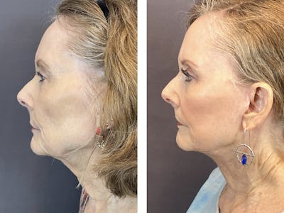 Facelift Before & After Gallery - Patient 122889161 - Image 2