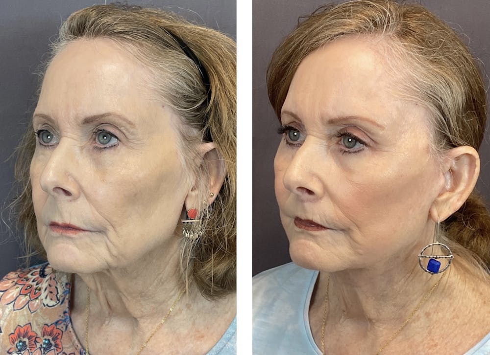 Facelift Before & After Gallery - Patient 122889161 - Image 3