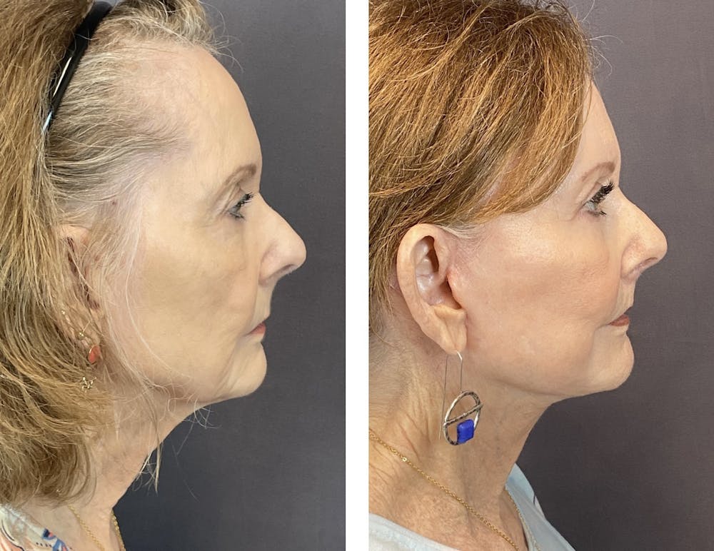 Facelift Before & After Gallery - Patient 122889161 - Image 4