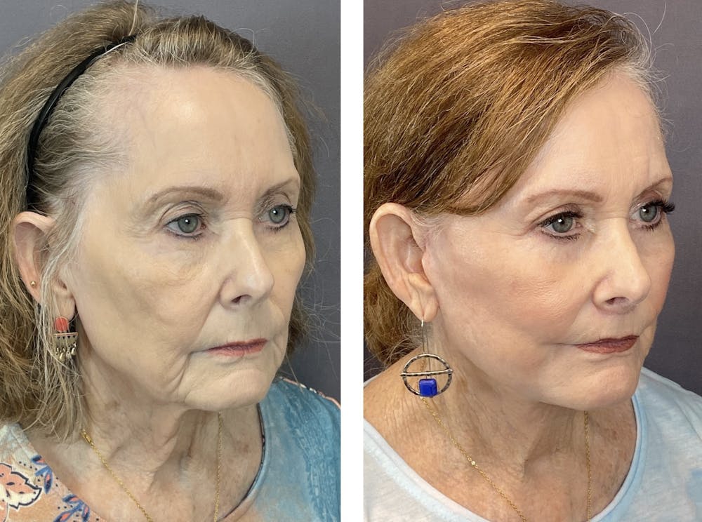 Facelift Before & After Gallery - Patient 122889161 - Image 5
