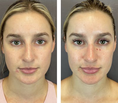 BOTOX Before & After Gallery - Patient 141758492 - Image 1