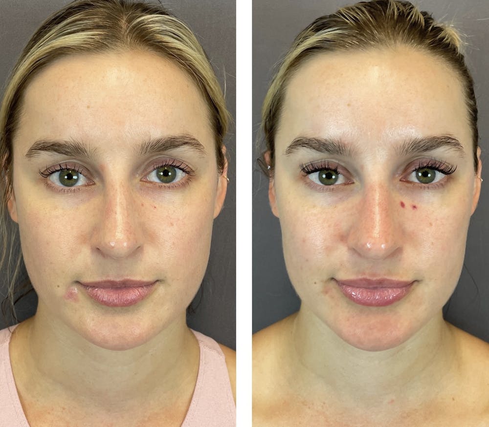 BOTOX Before & After Gallery - Patient 141758492 - Image 1