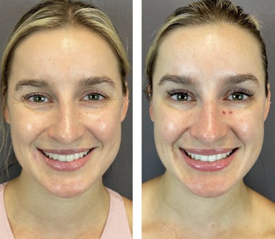 BOTOX Before & After Gallery - Patient 141758492 - Image 2