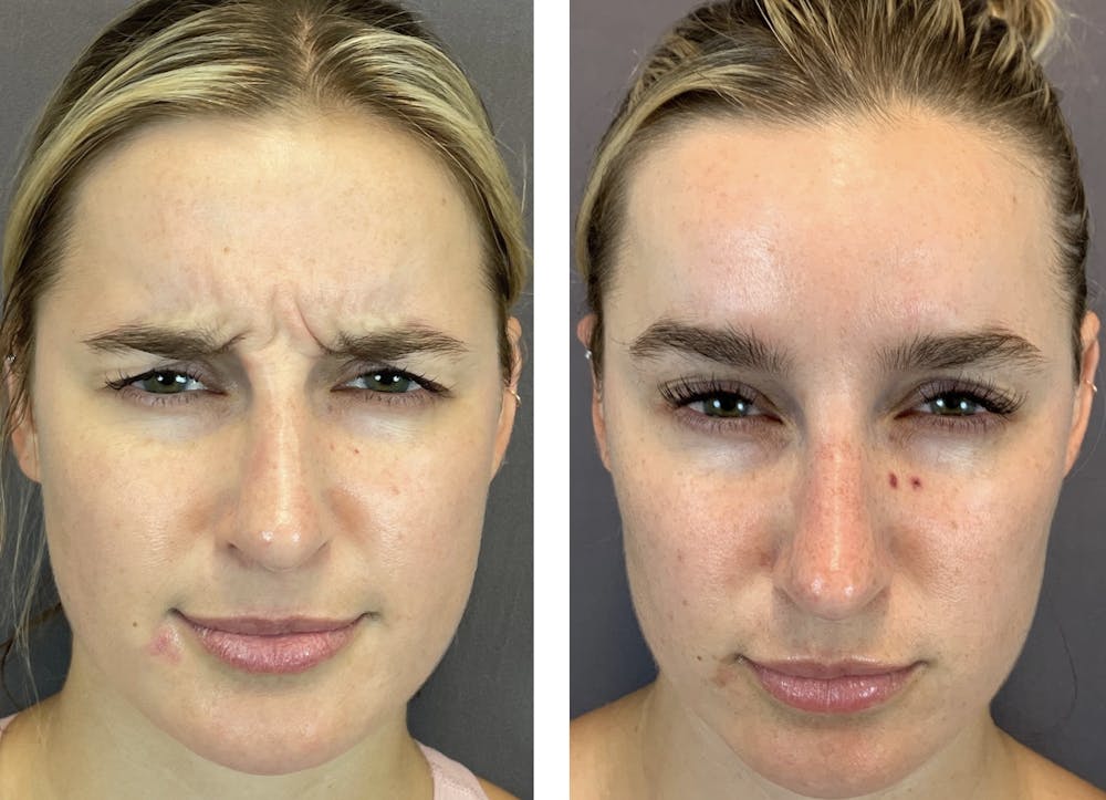 BOTOX Before & After Gallery - Patient 141758492 - Image 3