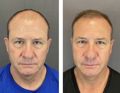 Hair Restoration  Before & After Gallery - Patient 141758557 - Image 1