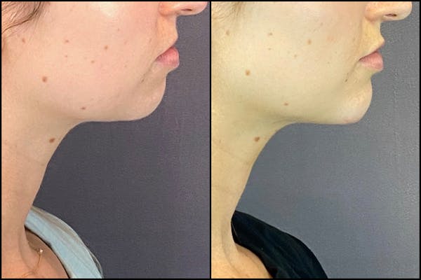 Dermal Fillers Before & After Gallery - Patient 141788349 - Image 4