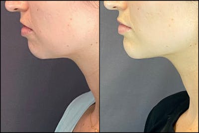 Dermal Fillers Before & After Gallery - Patient 141788349 - Image 6