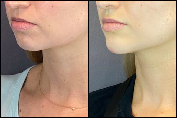 Dermal Fillers Before & After Gallery - Patient 141788349 - Image 5
