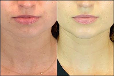 Dermal Fillers Before & After Gallery - Patient 141788349 - Image 1