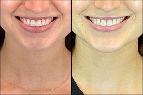 Dermal Fillers Before & After Gallery - Patient 141788349 - Image 2