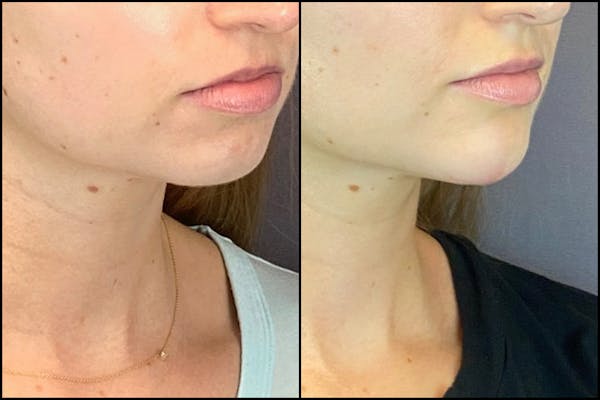 Dermal Fillers Before & After Gallery - Patient 141788349 - Image 3