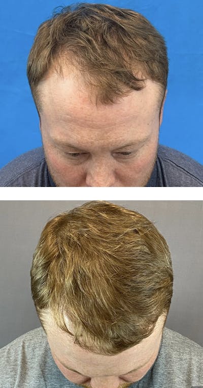 Hair Restoration  Before & After Gallery - Patient 141788382 - Image 1