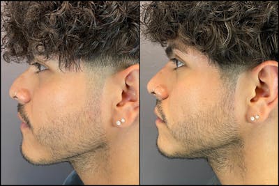 Non-Surgical Rhinoplasty Before & After Gallery - Patient 141788415 - Image 2