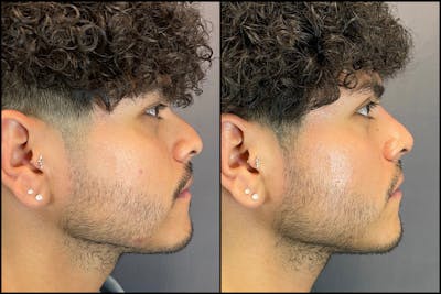 Non-Surgical Rhinoplasty Before & After Gallery - Patient 184431 - Image 1