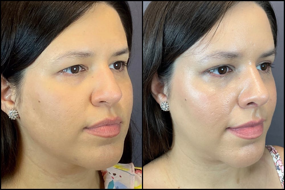 Rhinoplasty Before & After Gallery - Patient 141788545 - Image 2