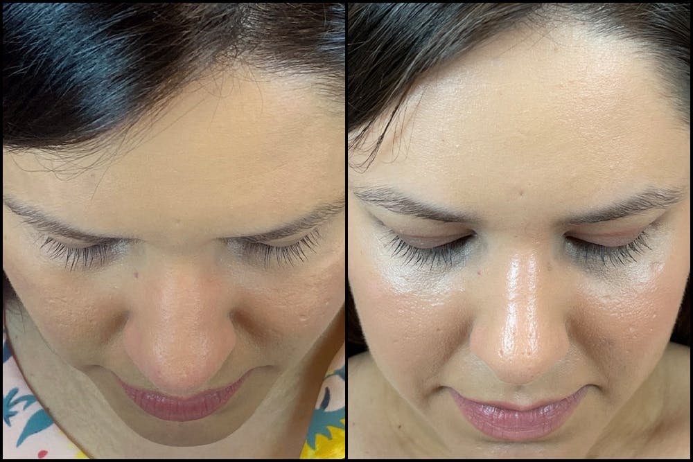 Rhinoplasty Before & After Gallery - Patient 141788545 - Image 6