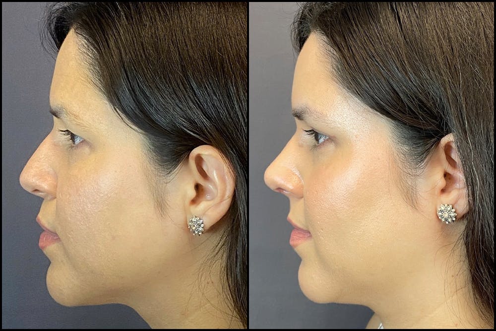 Rhinoplasty Before & After Gallery - Patient 141788545 - Image 3