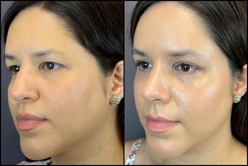 Rhinoplasty Before & After Gallery - Patient 141788545 - Image 4