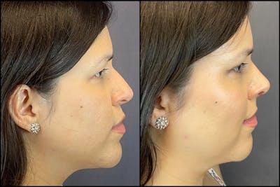Rhinoplasty Before & After Gallery - Patient 141788545 - Image 1
