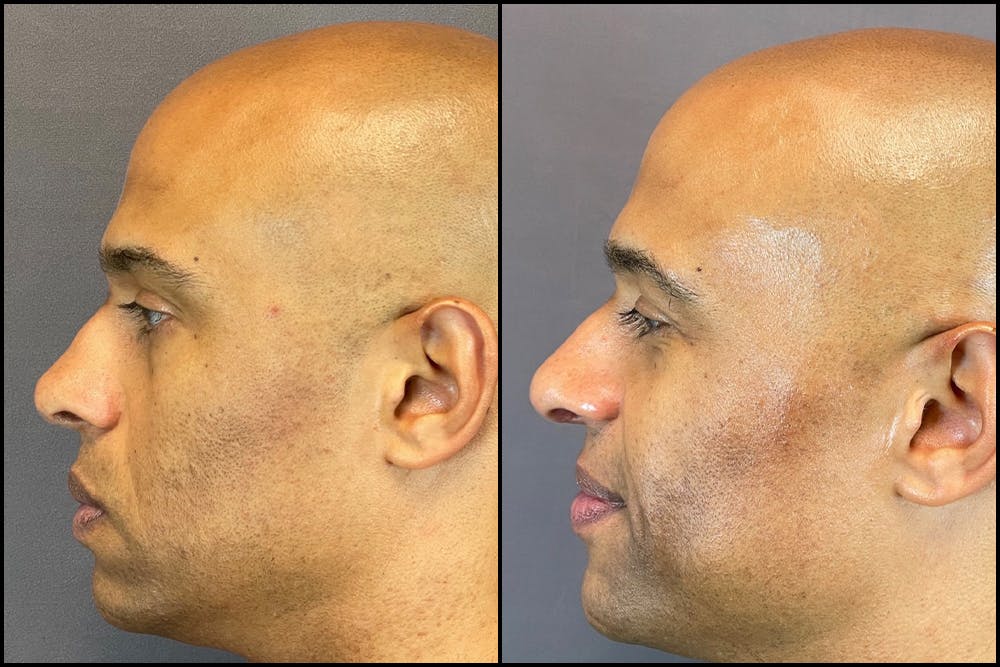 Rhinoplasty Before & After Gallery - Patient 141788647 - Image 3