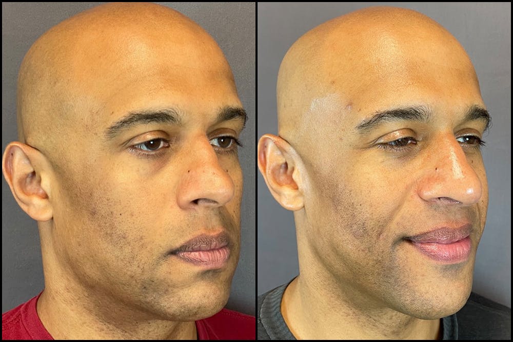Rhinoplasty Before & After Gallery - Patient 141788647 - Image 2