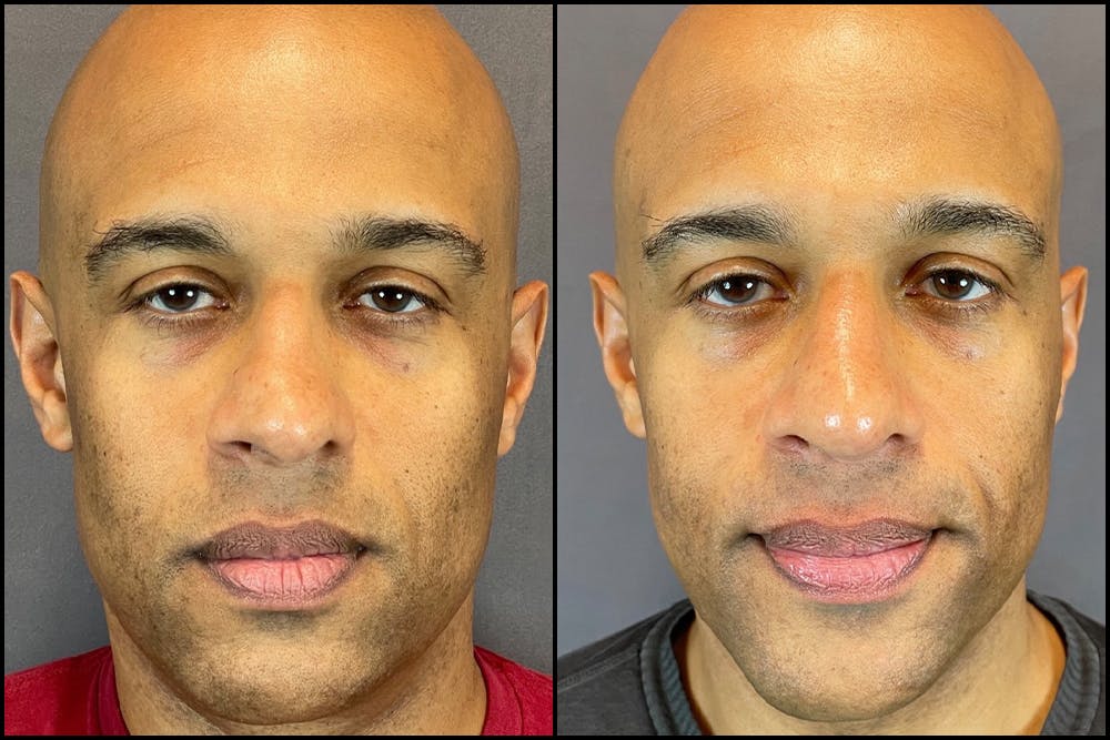 Rhinoplasty Before & After Gallery - Patient 141788647 - Image 5