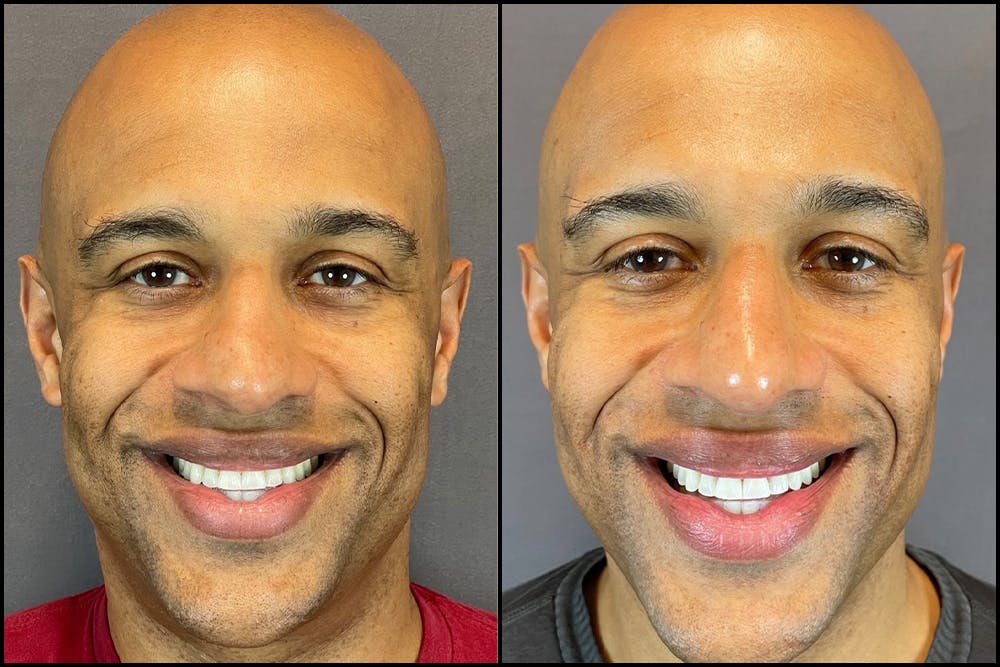 Rhinoplasty Before & After Gallery - Patient 141788647 - Image 6