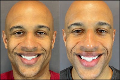 Rhinoplasty Before & After Gallery - Patient 141788647 - Image 6