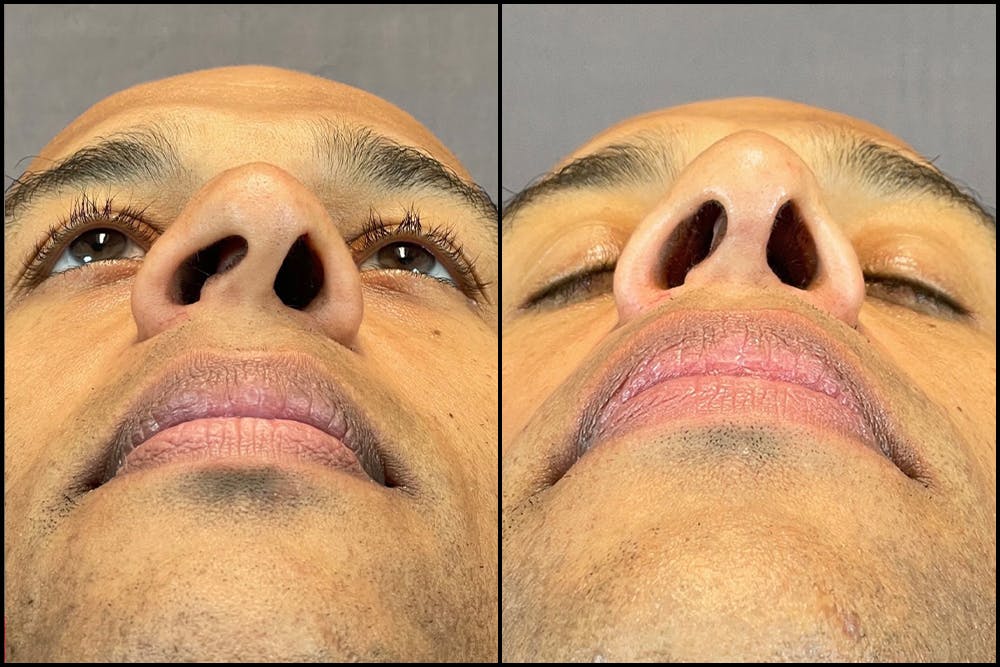 Rhinoplasty Before & After Gallery - Patient 141788647 - Image 7